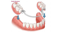 Dentures