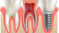 Dental Implants Surrey