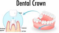 Inlays, Onlays and Crowns