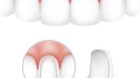 Dental Veneers Surrey