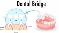 Dental Bridges Surrey