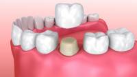 Dental crowns