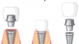 Dental Implant