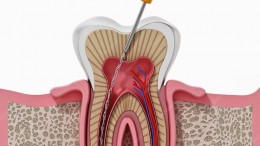 Full Mouth Implant