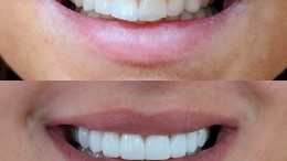 Composite Veneers